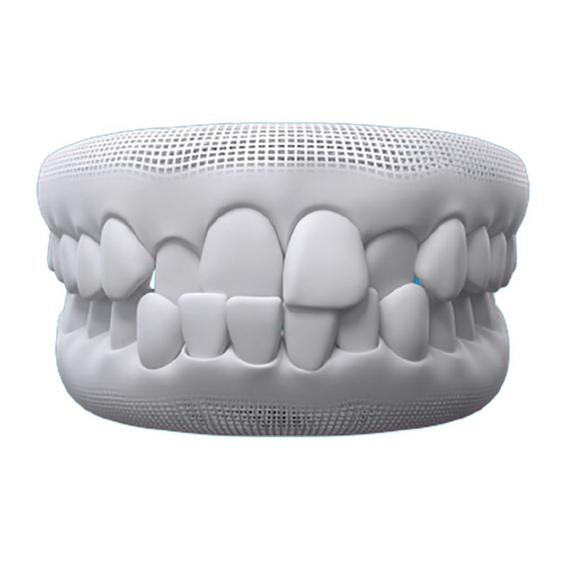 Crossbite