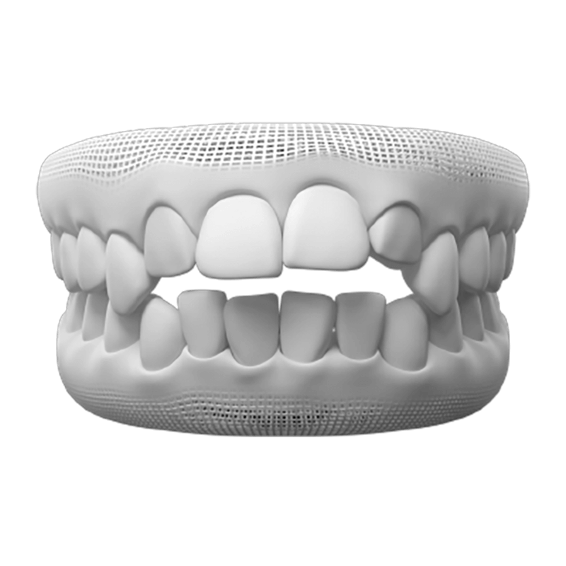 Open bite