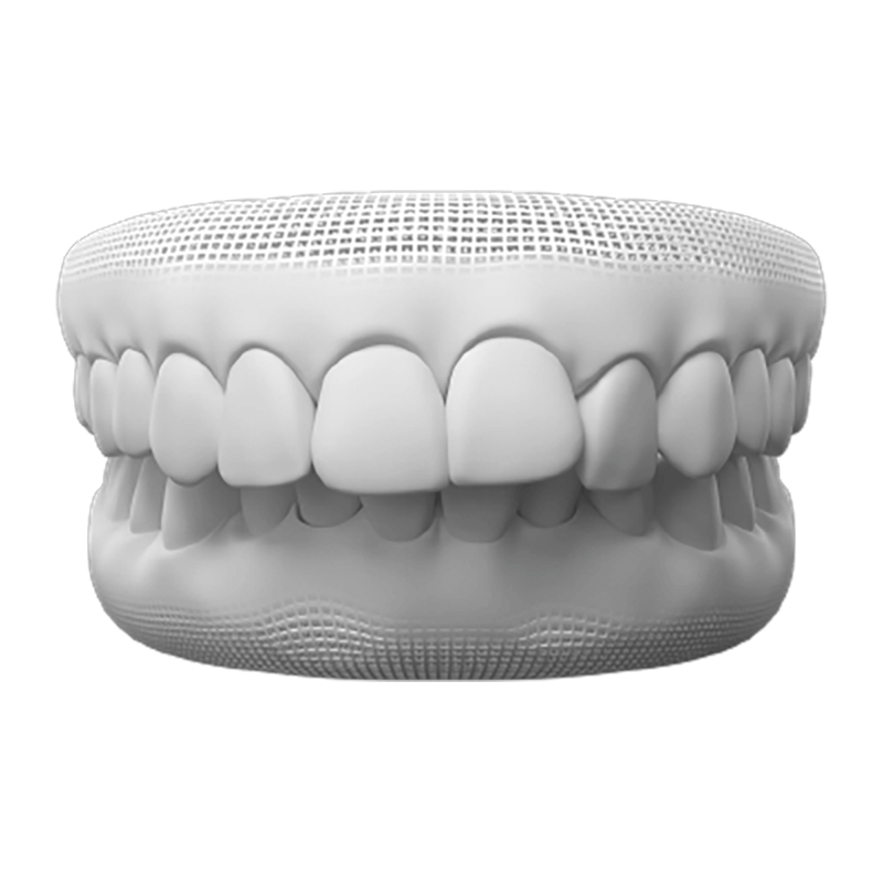 Overbite